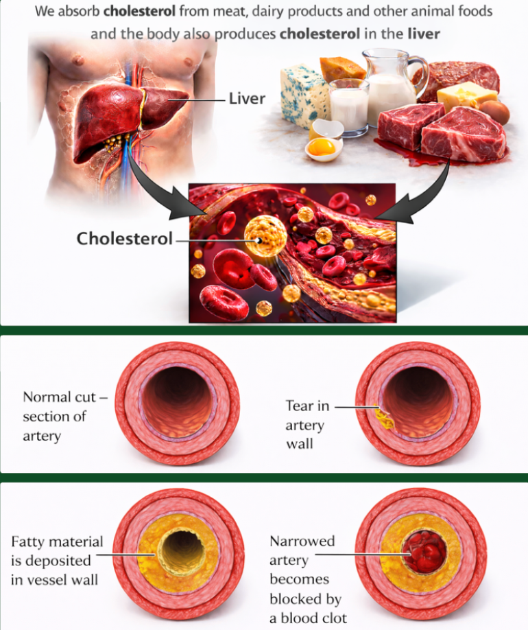 Diagram of cholesterol and artery health improving with a plant-based diet and consistent training